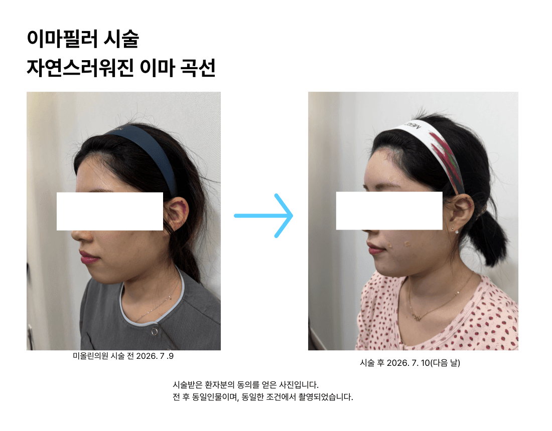 필러는 많이 넣을수록 좋아지지 않습니다