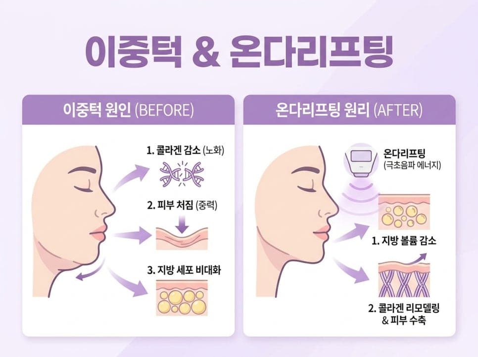 온다리프팅 이중턱 처짐을 예방하는 올바른 리프팅 선택 기준